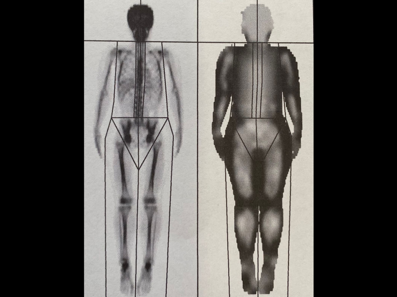 densitometria-osea-4